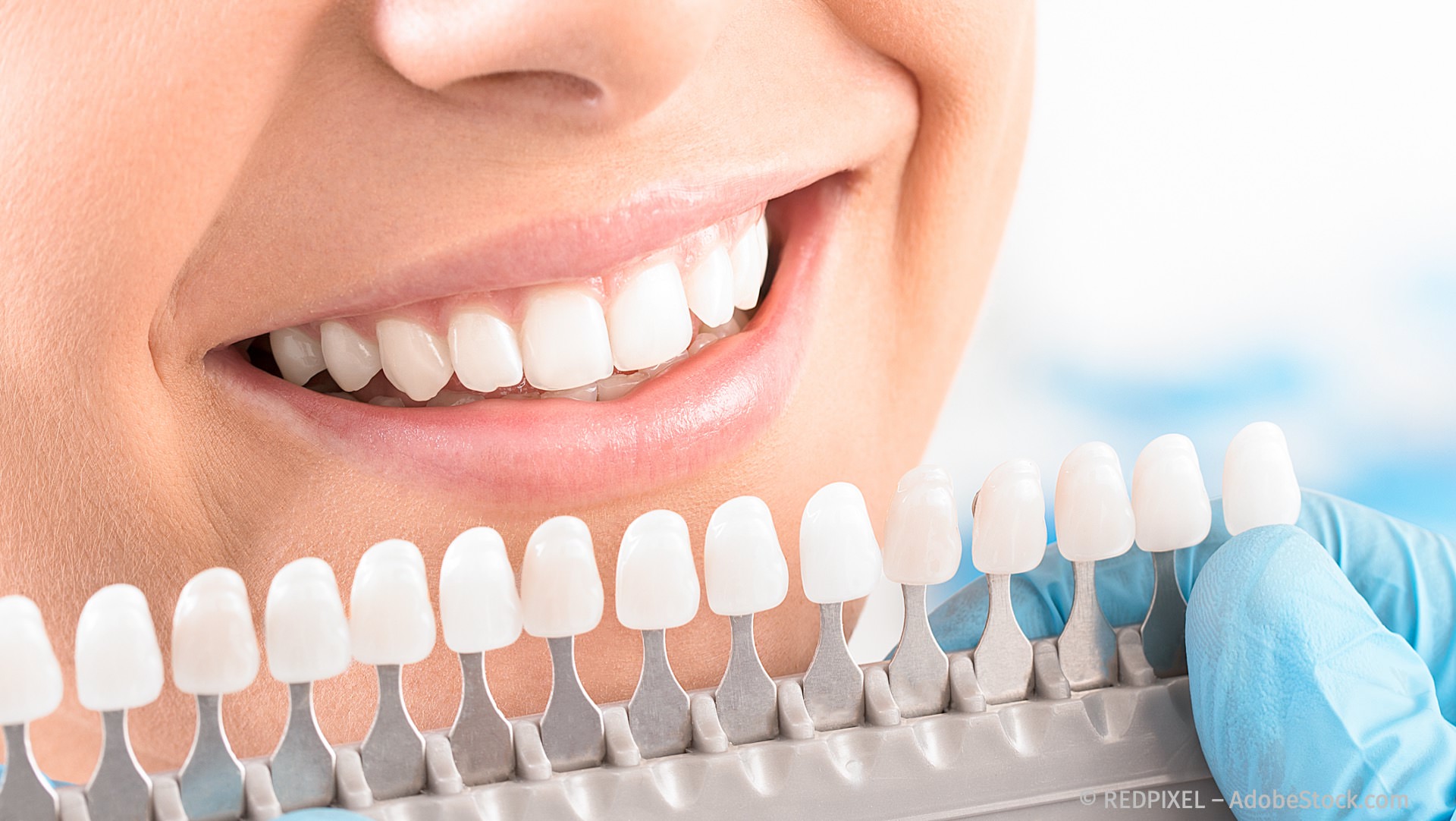 Bleaching: weiße Zähne mit Zahnaufhellung