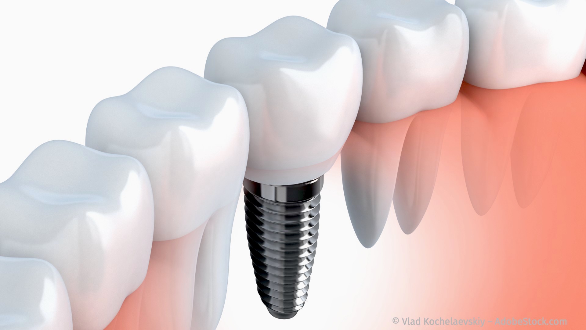 Zahnimplantate zum Ersatz fehlender Zähne