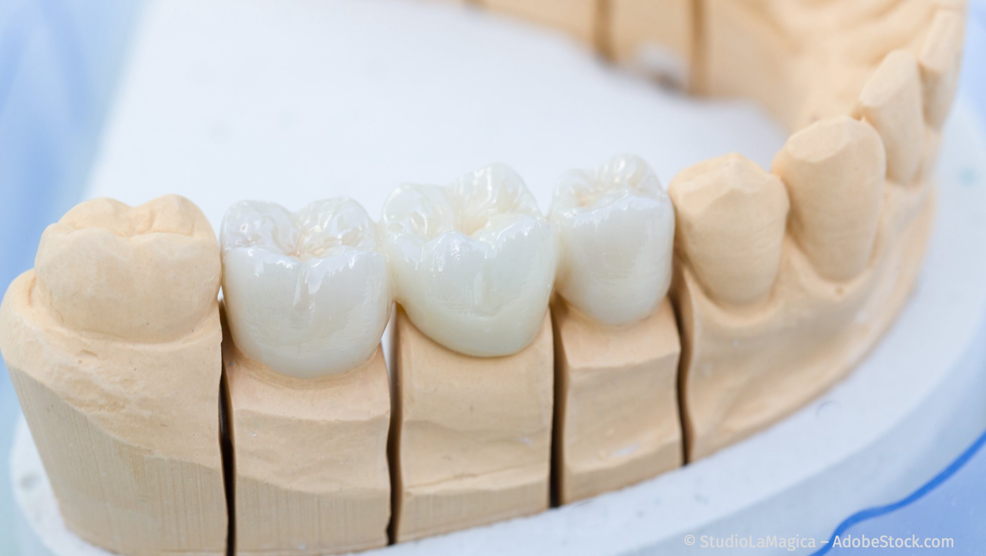Zahnersatz: Zahnkronen und Zahnbrücken aus reiner Keramik